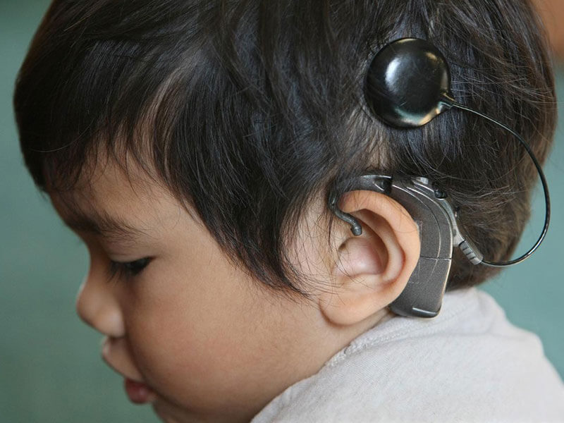 cochlear implant program